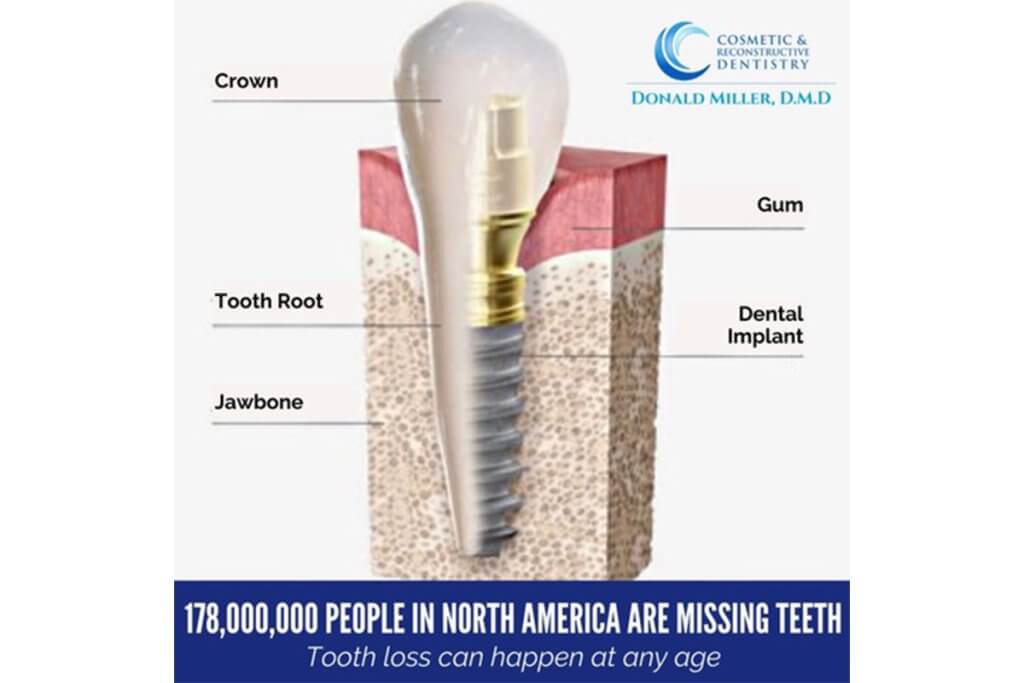 4 Myths About Dental Implants Cosmetic & Reconstructive Dentistry