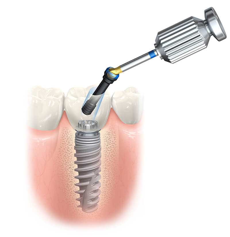 Dental Implant Placement in Fairfield, CT