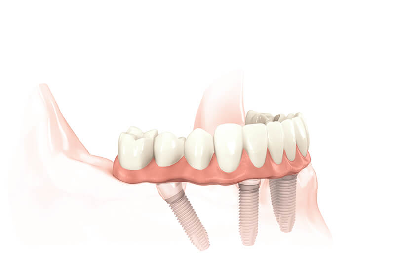 Implant Supported Dentures in Fairfield, CT