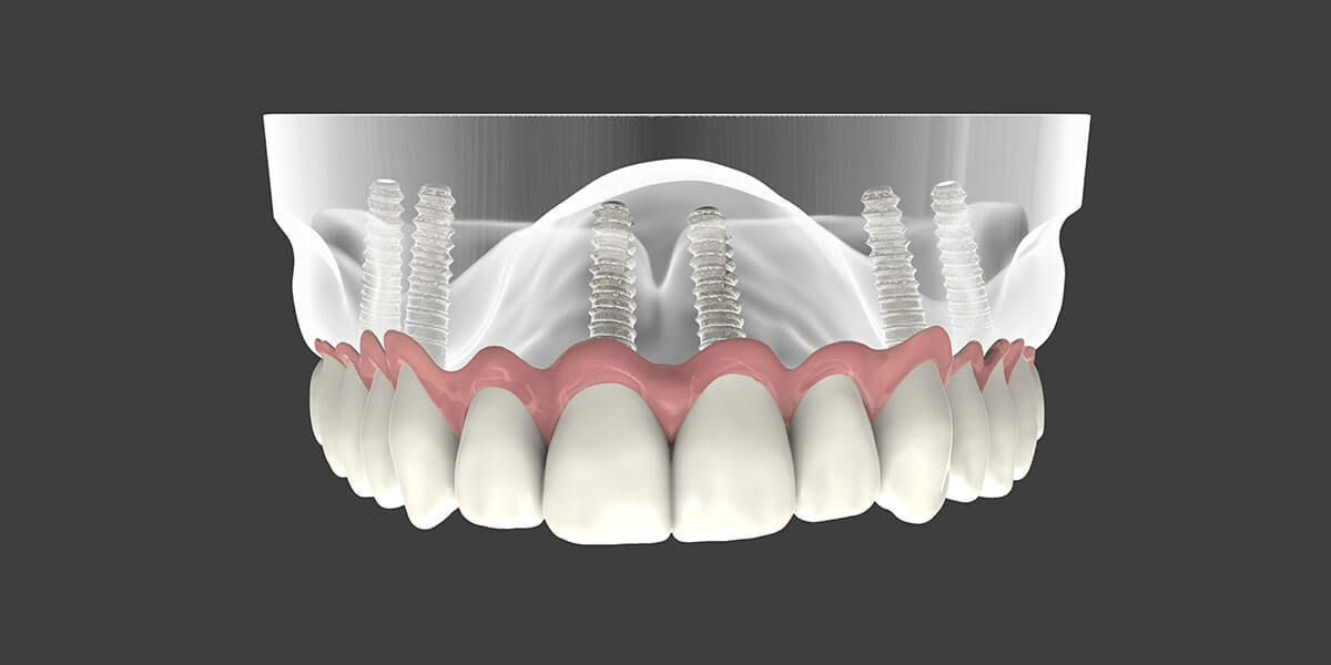 Dental Implant Supported Dentures