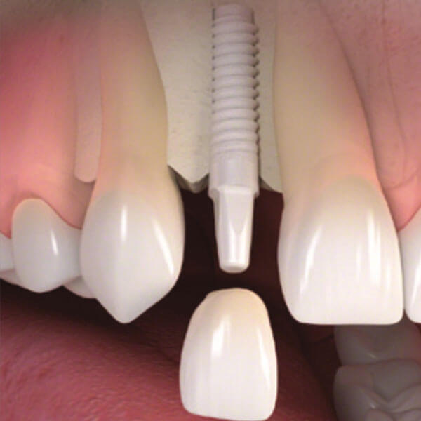 Dental Implant Placement in Fairfield, CT