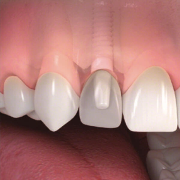 Implant Supported Dentures in Fairfield, CT
