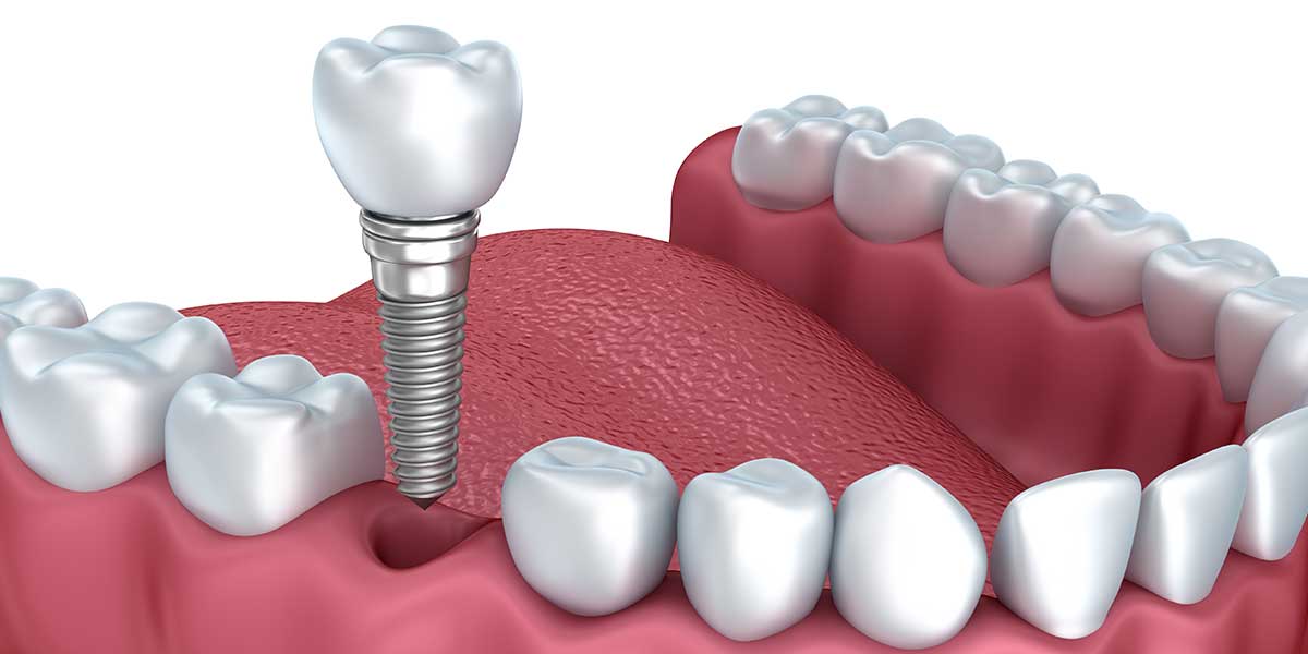 Single Dental Implants in Fairfield, CT