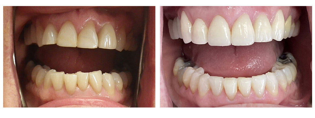 Before after teeth