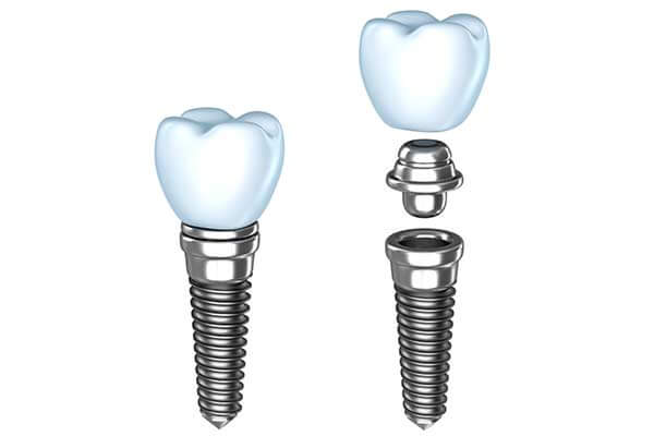 Single Dental Implants in Fairfield, CT