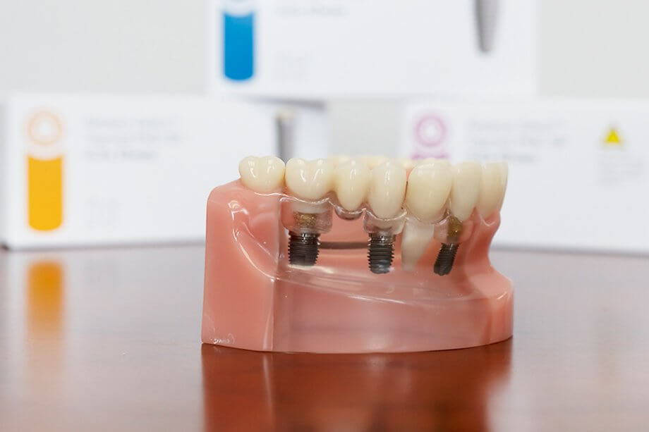 model of dental implants