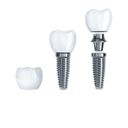 Dental Implants Image