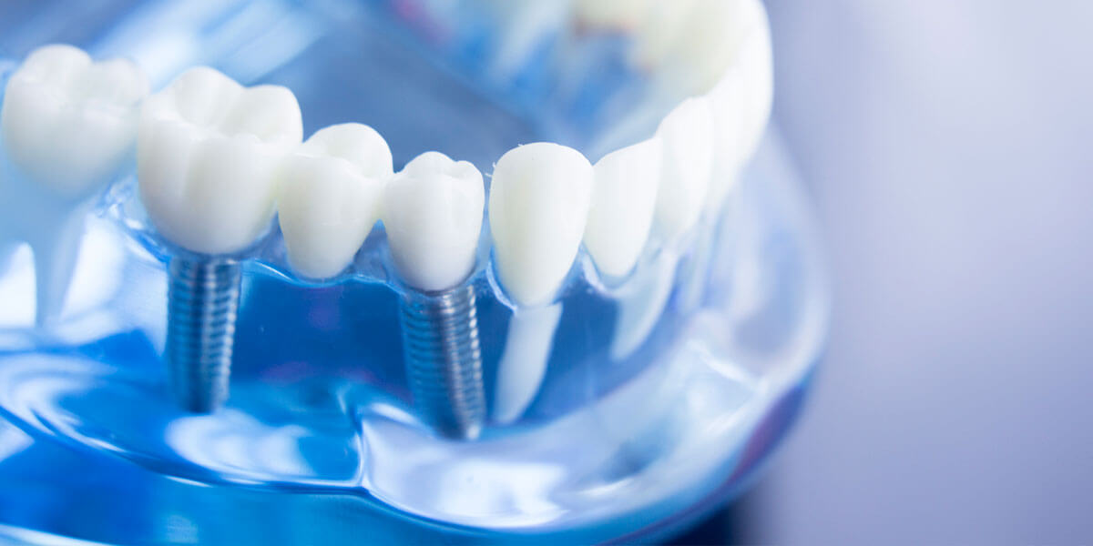 Benefits of Dental Implants in Fairfield