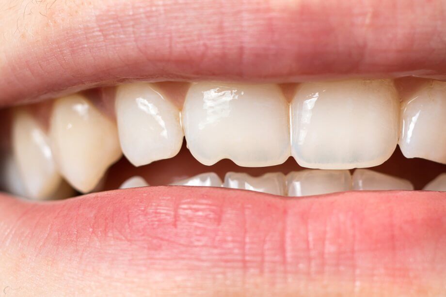White Spots on Teeth: What They Are and How to Remove Them